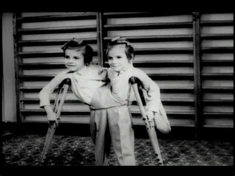 conjoined twins masha and dasha|The Mysterious Case of Petr Anokhin, Soviet .